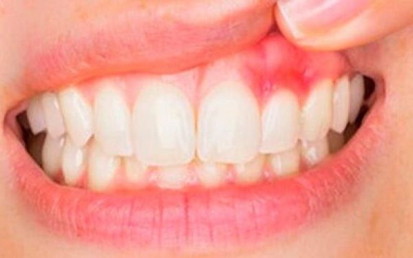 التهاب لثه را چگونه درمان کنیم؟ التهاب لثه را چگونه درمان کنیم؟