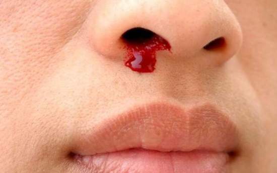 روش‌های درمان خانگی خون دماغ چیست؟